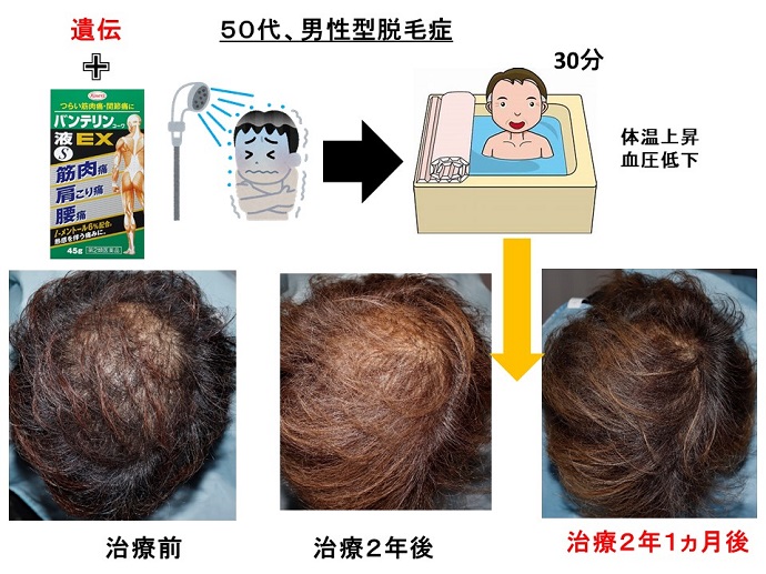 円形脱毛症　病院